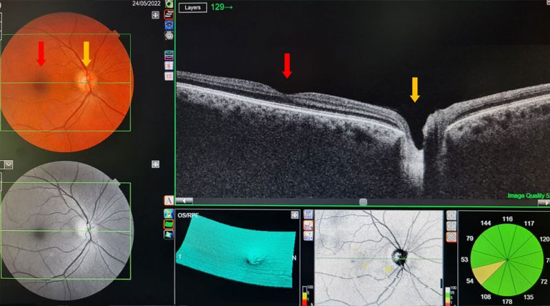 Wie Lange Dauert Eine Angiographie Am Auge www.augenarzt-hn.de